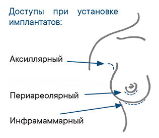 Доступы увеличения груди